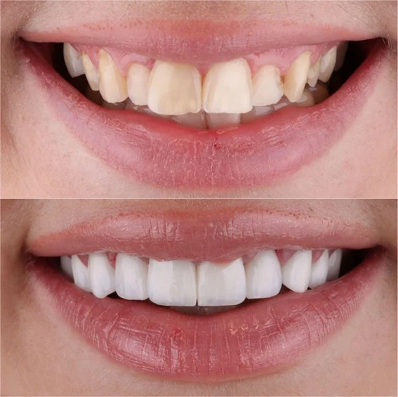 Hollywood smile - Keramičke navlake i viniri