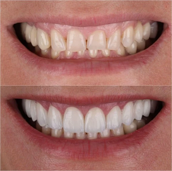 Analiza osmijeha i planiranje Hollywood smile