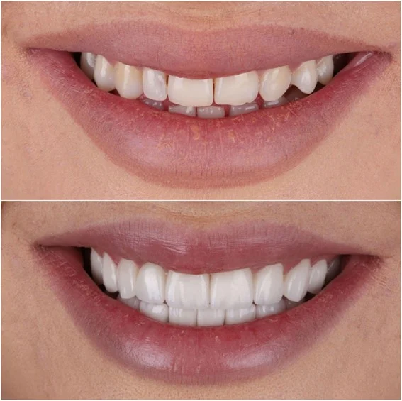 Proces postavljanja vinira i navlaka