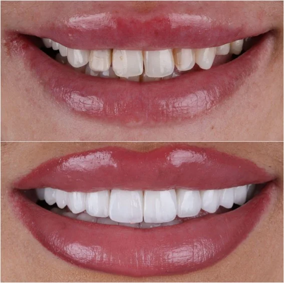 Održavanje i njega Hollywood smile