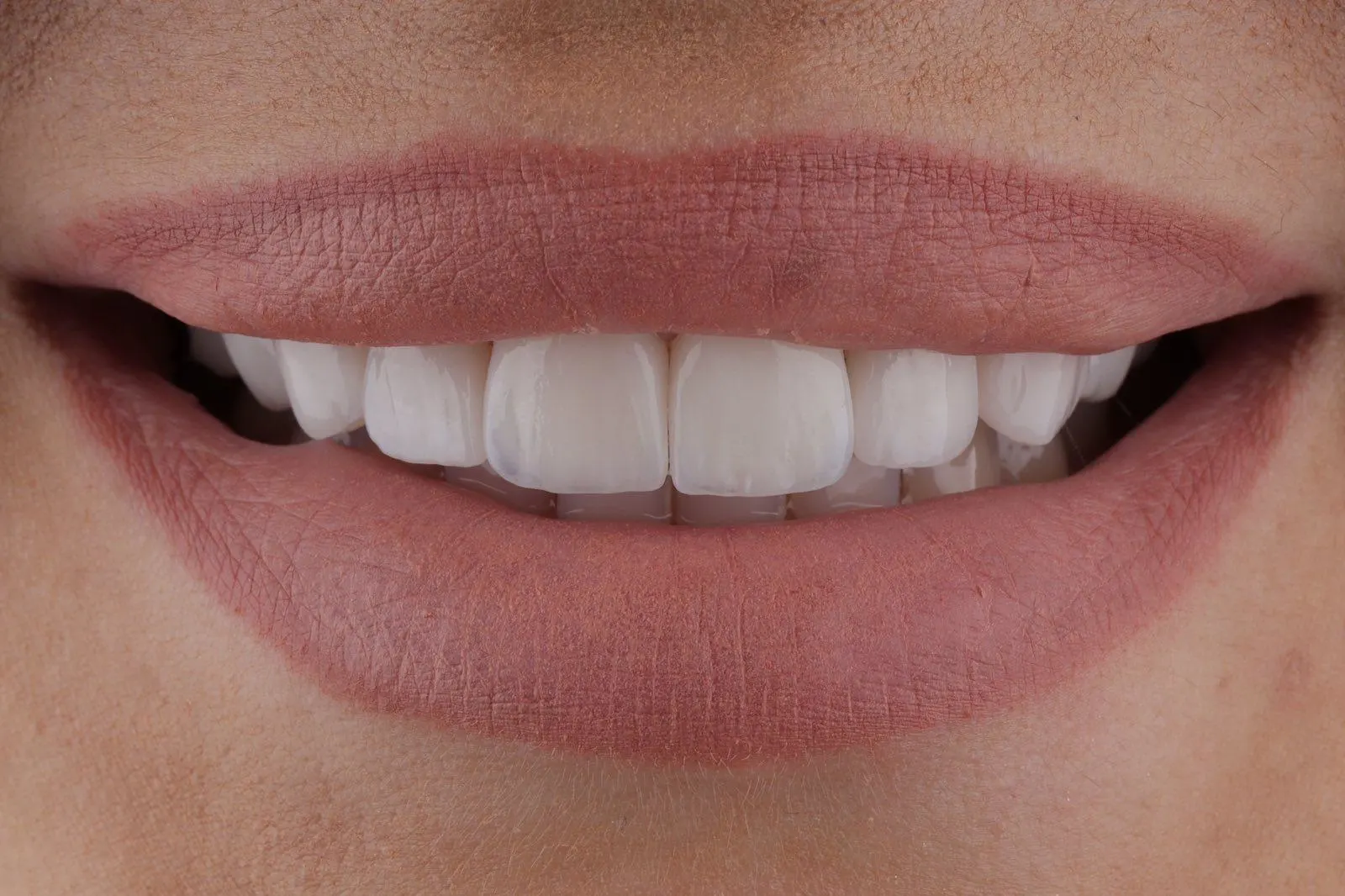 Hollywood smile Saraj dent Sarajevo – keramički viniri