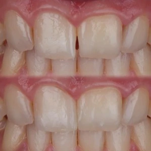 Kompozitne nadopune – konačan rezultat