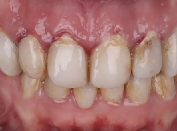 Loša gingiva i povlačenje desni