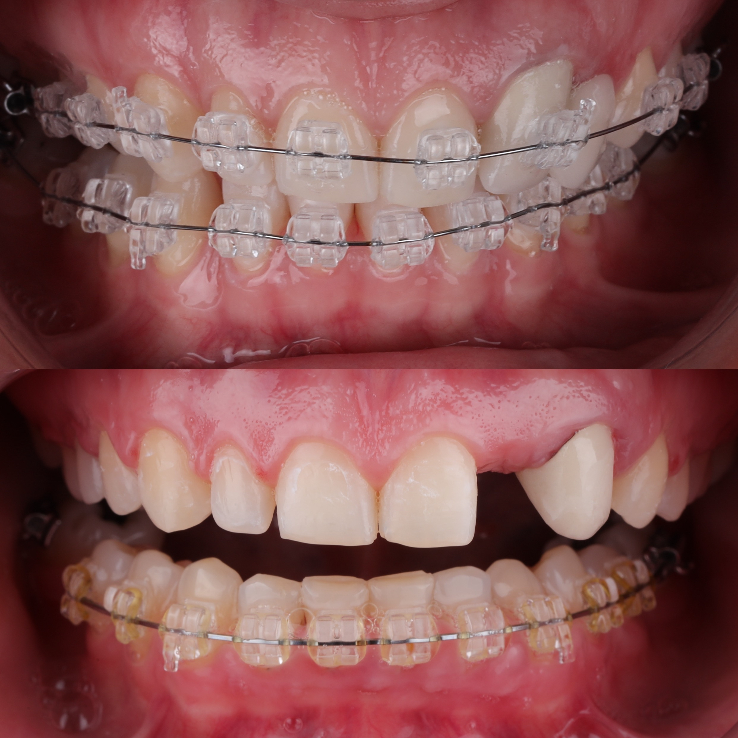 Orthodontic treatment - treatment phases
