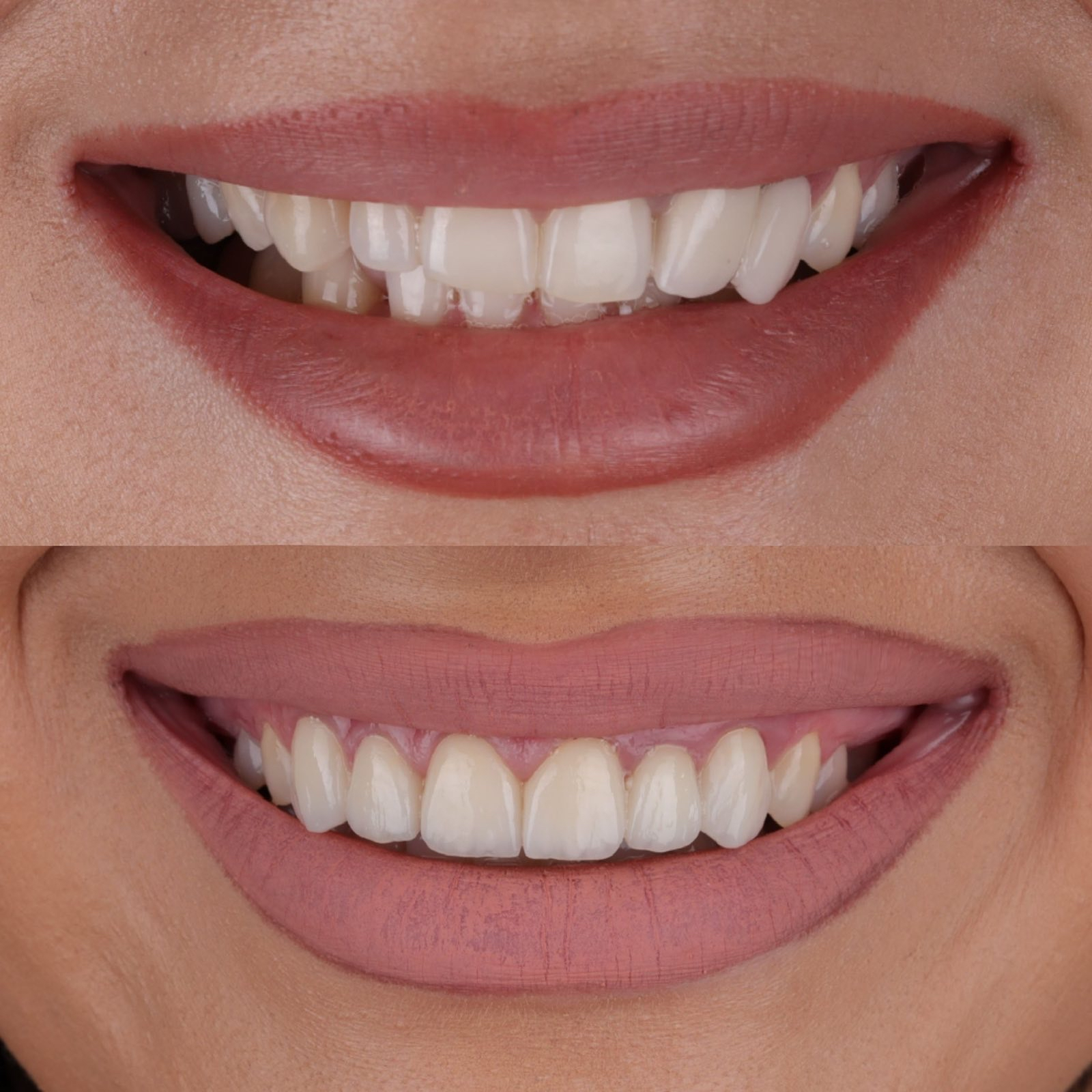 Smile transformation - before and after treatment