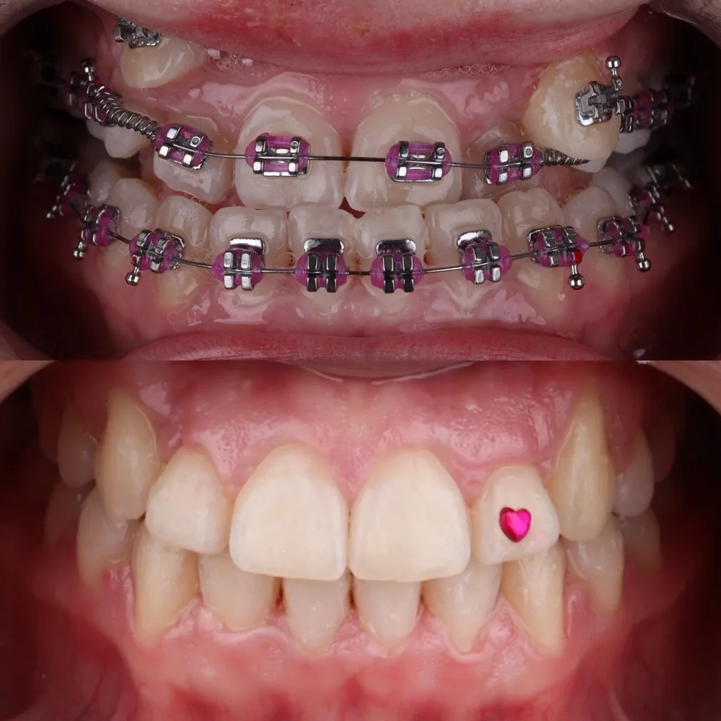 Prije i poslije tretmana fiksnim ortodontskim aparatićem – Saraj Dent Sarajevo